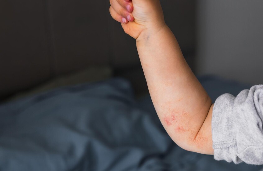 اكتشاف عوامل خطر غير متوقعة لحساسية الطعام عند الأطفال